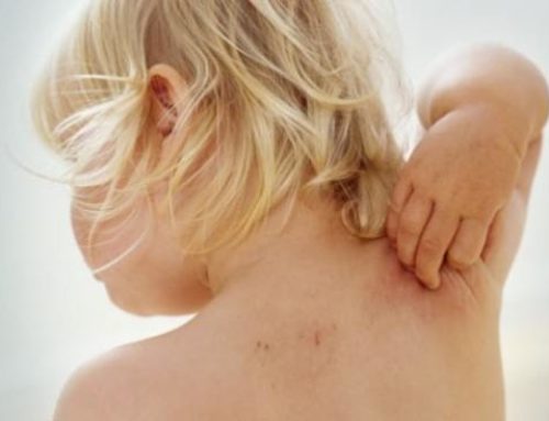 “Silk Fails to Sooth Kids’ Eczema”, Says Recent Study