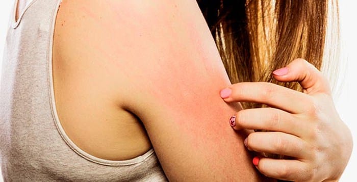 Professional Skin Allergists Offering Skin Allergy Treatment Near Queen Creek, AZ