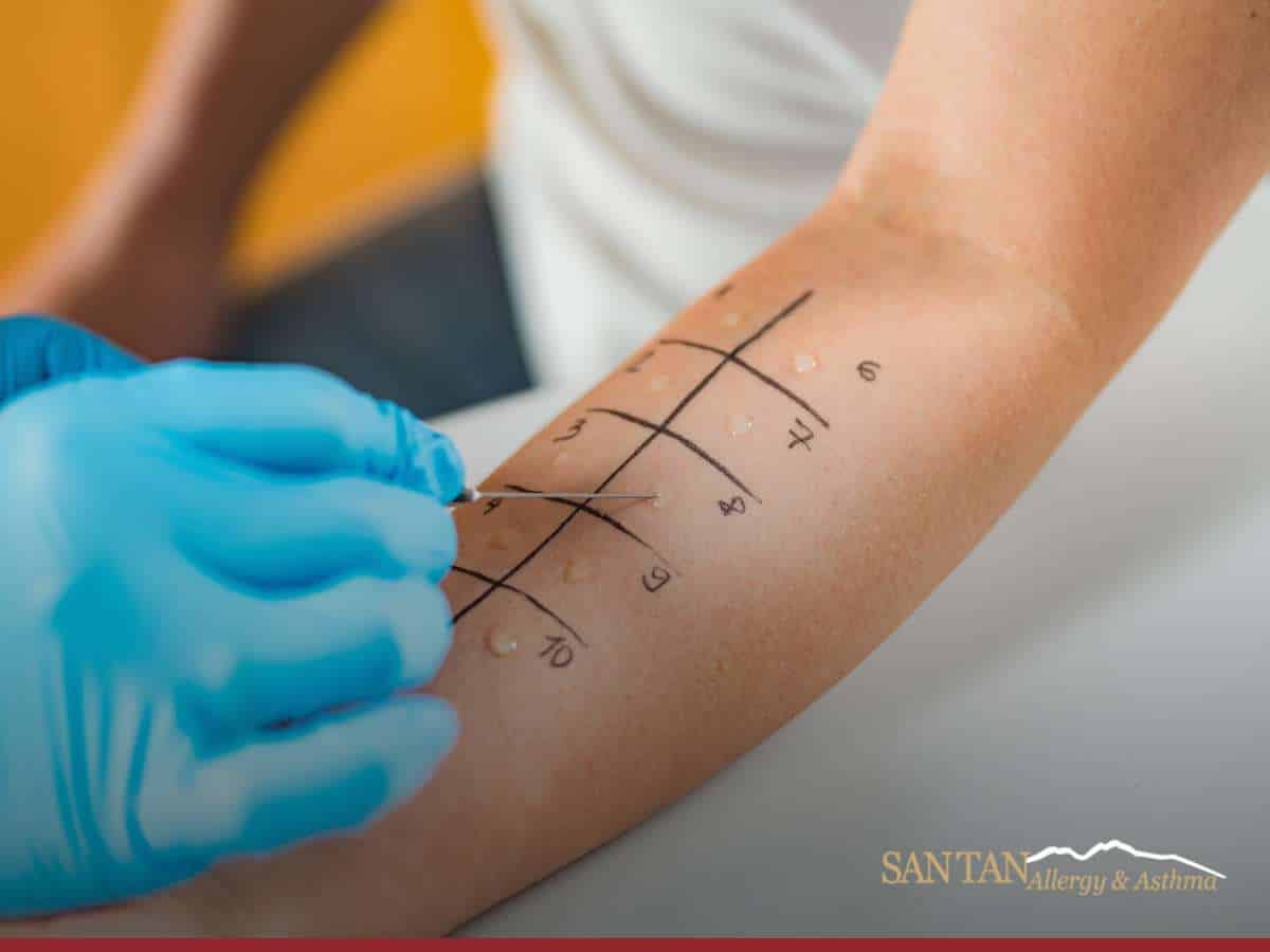 Allergist performing a Skin Prick test on a patient