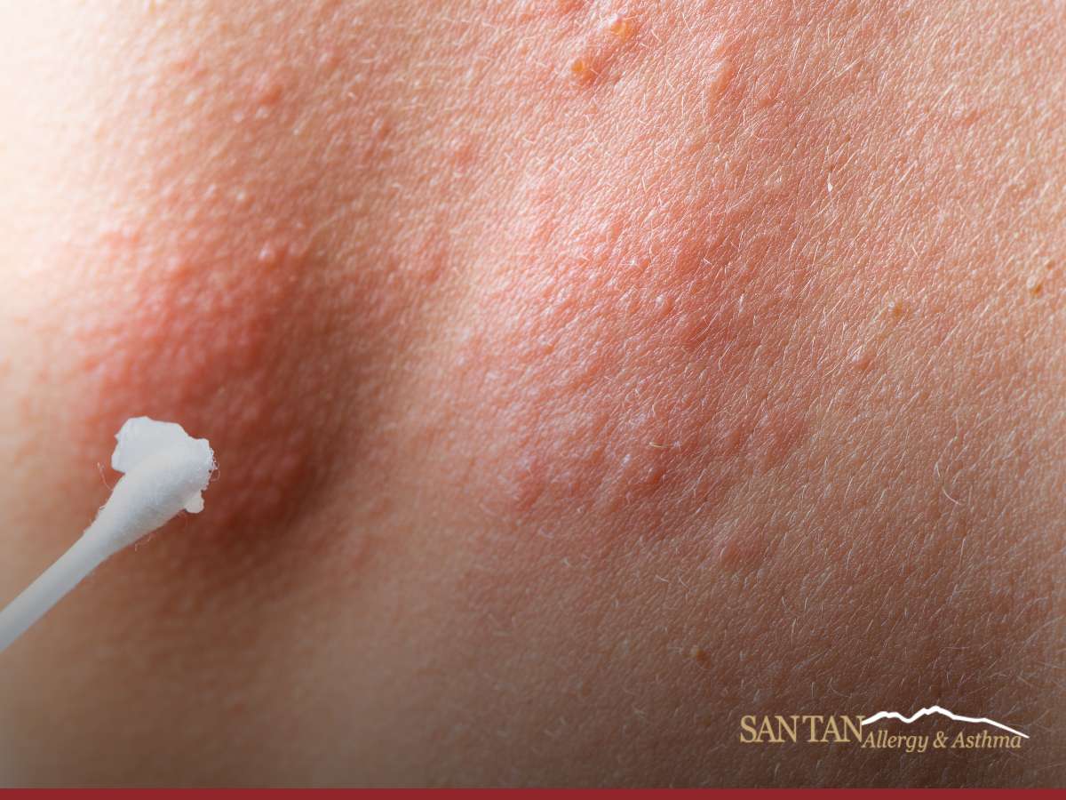 Person experiencing hives on skin that can be treated with an gilbert allergy expert