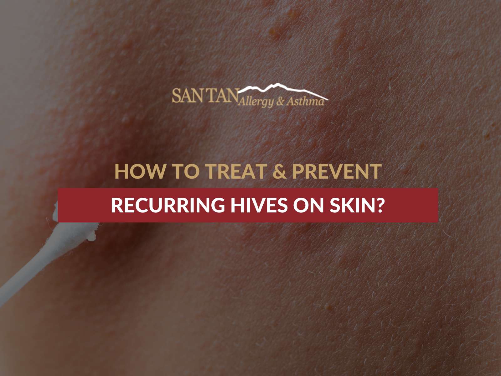 How To Treat & Prevent Recurring Hives On Skin