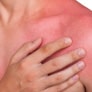 Sensitive Skin Is A Sign Of Eczema