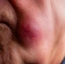 Inflamed Skin Is A Sign Of Eczema