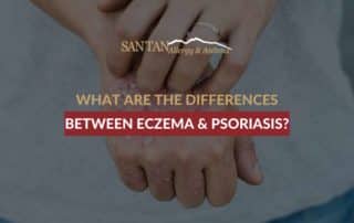 What Are the Differences Between Eczema & Psoriasis?