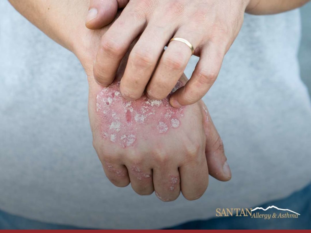 What Are The Differences Between Eczema & Psoriasis?