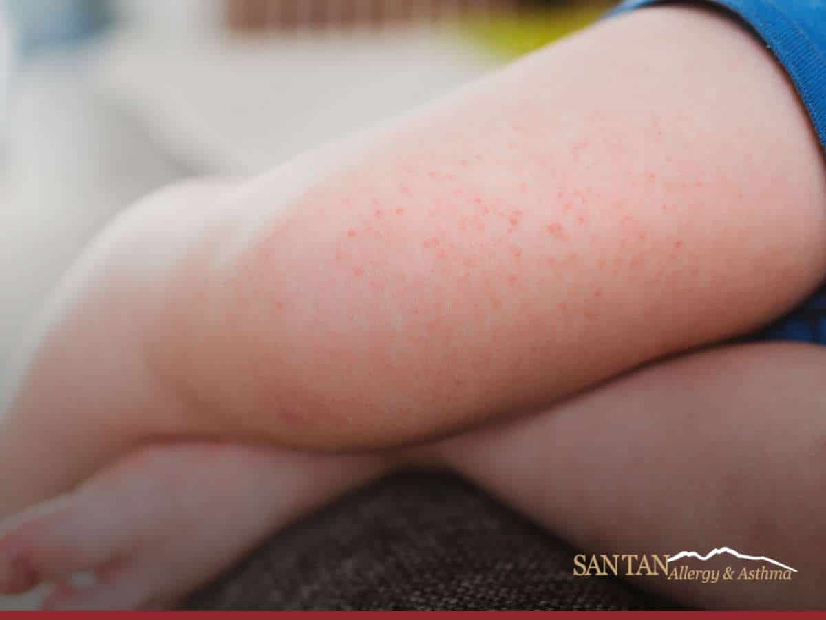 Red rash on child's leg - a common symptom in children with food allergies