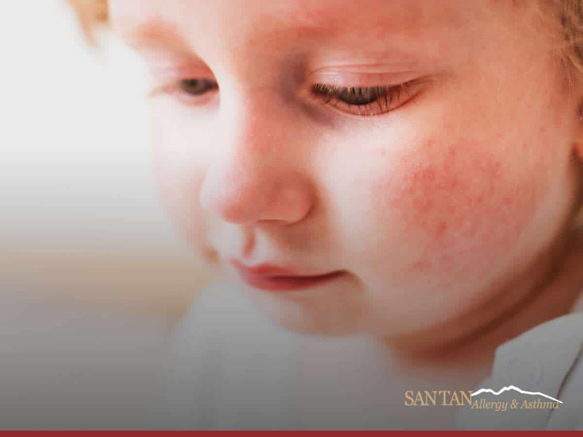 Child with facial rash possibly caused by peanut allergies